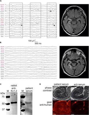 Stereotactically Injected Kv1.2 and CASPR2 Antisera Cause Differential Effects on CA1 Synaptic and Cellular Excitability, but Both Enhance the Vulnerability to Pro-epileptic Conditions